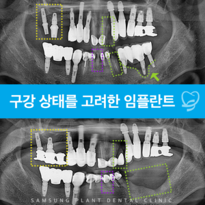 구강 상태를 고려한 임플란트