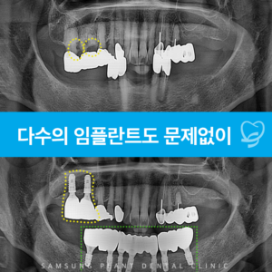 다수의 임플란트도 문제없이