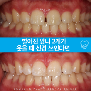 신정동앞니치료