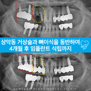 상악동거상술과 뼈이식을 동반하여