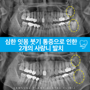 심한 잇몸 붓기 통증으로 인한 2개의 사랑니 발치