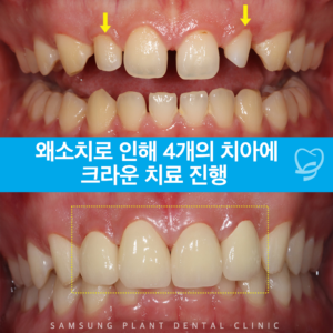 왜소치로인해 4개의치아에 크라운치료진행