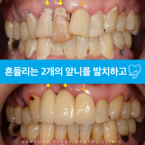 치료전후