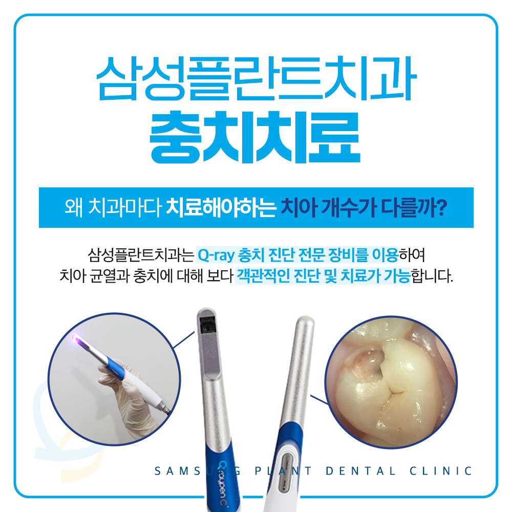 삼성플란트치과 충치치료
