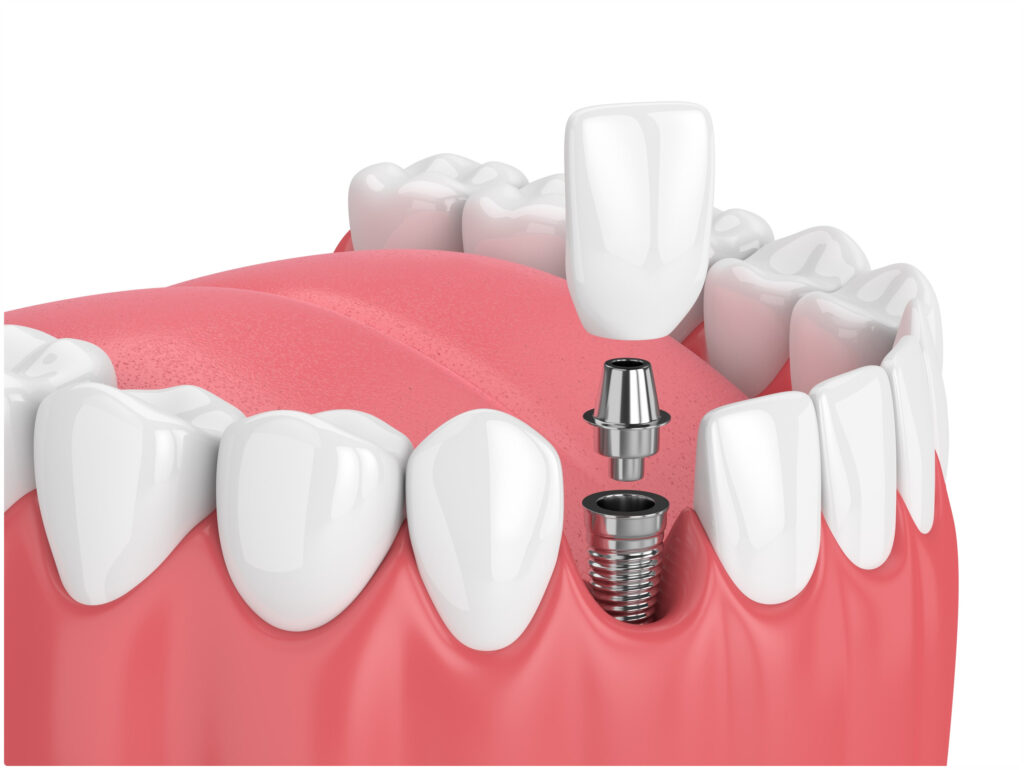 신정동임플란트
