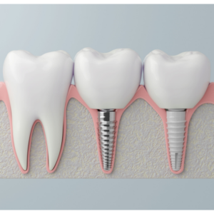 신정동임플란트