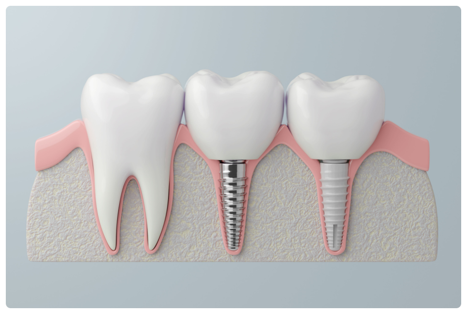 신정동임플란트